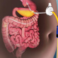 Gastric Band Surgery for Medical Weight Loss